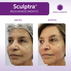 Sculptra Antes e Depois